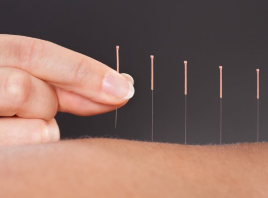 Ace acupunctura